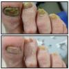 Onicomicosis con onicofosis, tratada en primera sesión