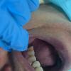 despues con recinas cervicales