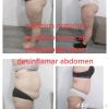 Técnicas combinadas para reducción abdominal y retención de líquidos