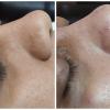 Limpieza facial profunda